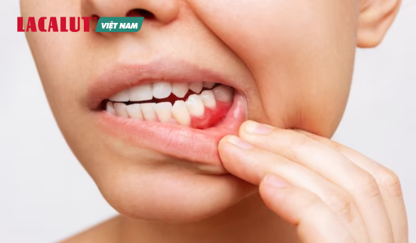 viêm nướu khiến răng ê buốt