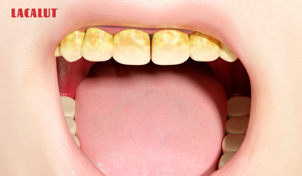 mảng bám cao răng khiến răng bị ê buốt