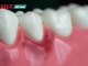 răng ê buốt chảy máu báo hiệu viêm nướu