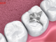trám răng khắc phục tình trạng răng bị ê buốt khi uống nước